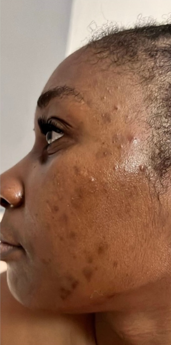 Piel con acné hormonal y manchas antes del tratamiento