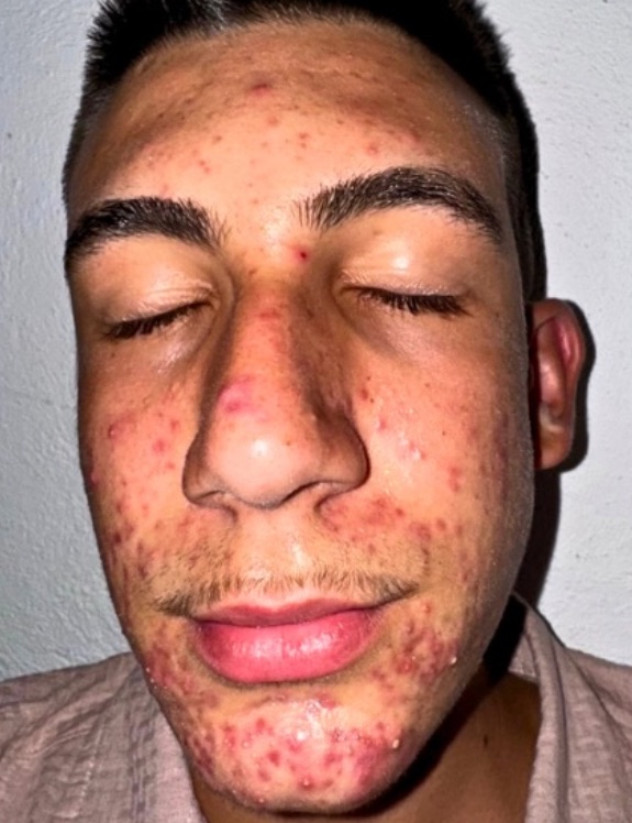 Piel con acné severo antes del tratamiento
